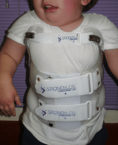 Infantile Scoliosis